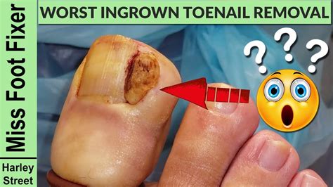 reddit ingrown toenail|how to fix impacted toenail.